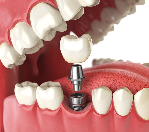 Snellville Will I Need a Bone Graft for Dental Implants