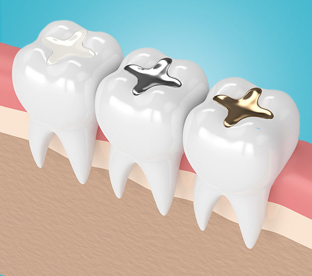 Snellville Composite Fillings