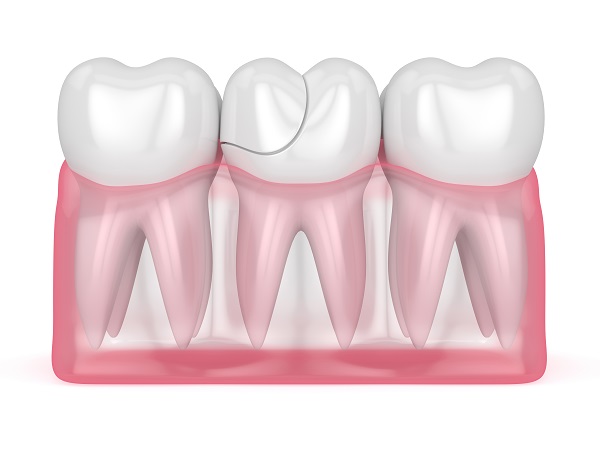 What To Do If You Think You Have A Cracked Tooth