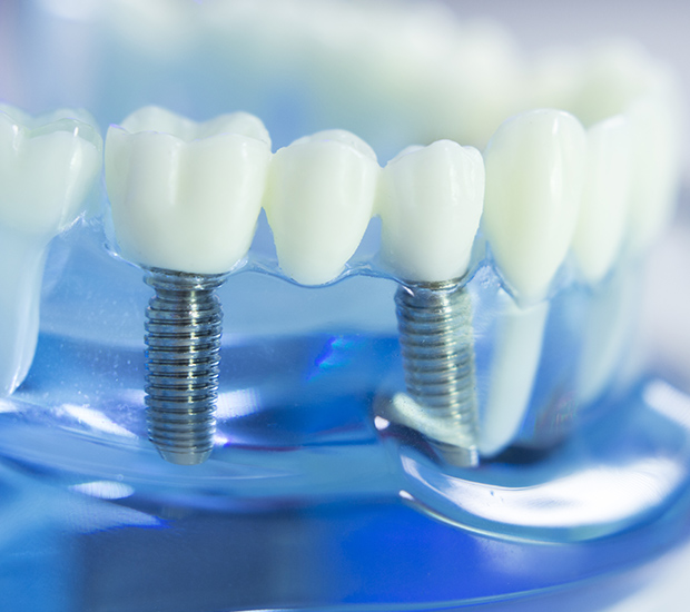 Snellville Dental Implants
