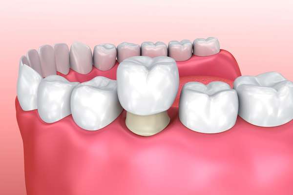 Permanent Dental Crowns vs. Temporary: Is There a Difference from North Road Family Dental in Snellville, GA
