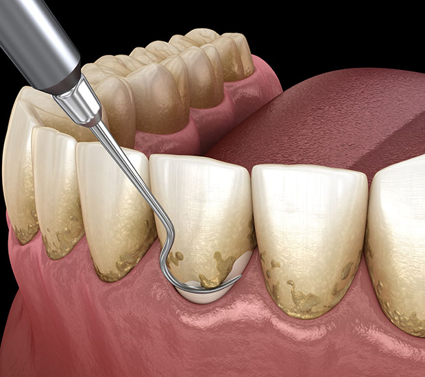 Snellville Root Scaling and Planing