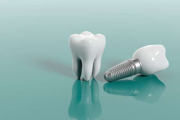 Multiple Teeth Replacement Options: One Implant for Two Teeth from North Road Family Dental in Snellville, GA